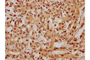 IHC image of nhibHU diluted at 1:8 and staining in paraffin-embedded human liver cancer performed on a Leica BondTM system. (HIST1H4A antibody  (AA 1-12))