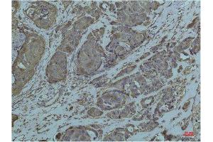 Immunohistochemistry (IHC) analysis of paraffin-embedded Human Breast Carcicnoma using GRP78/Bip Mouse Monoclonal Antibody diluted at 1:200. (GRP78 antibody)