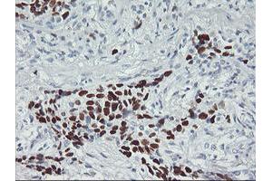 Immunohistochemical staining of paraffin-embedded Carcinoma of Human lung tissue using anti-TP53 mouse monoclonal antibody. (p53 antibody)