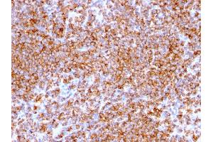 Formalin-fixed, paraffin-embedded human Lymphoma stained with CD20 Mouse Monoclonal Antibody (IGEL/773). (CD20 antibody)