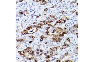 Immunohistochemistry of paraffin-embedded human colon carcinoma using TFF3 Rabbit mAb (ABIN1680916, ABIN3019077, ABIN3019078 and ABIN7101711) at dilution of 1:100 (40x lens). (TFF3 antibody)
