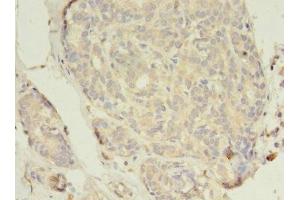Immunohistochemistry of paraffin-embedded human breast cancer using ABIN7152043 at dilution of 1:100 (Estrogen Receptor alpha antibody  (AA 10-591))
