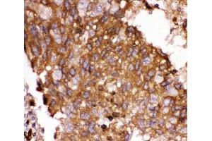 IHC-P: FOXO3A antibody testing of human lung cancer tissue (FOXO3 antibody  (AA 471-673))