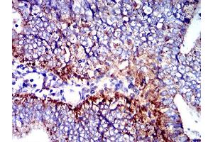 Immunohistochemical analysis of paraffin-embedded endometrial cancer tissues using CD107b mouse mAb with DAB staining. (LAMP2 antibody  (AA 29-168))