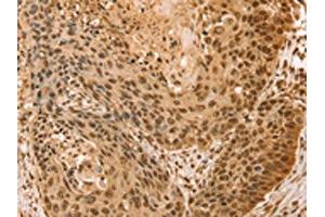 The image on the left is immunohistochemistry of paraffin-embedded Human esophagus cancer tissue using ABIN7131133(SNX8 Antibody) at dilution 1/25, on the right is treated with fusion protein. (SNX8 antibody)
