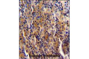 SYNE3 antibody immunohistochemistry analysis in formalin fixed and paraffin embedded human hodgkin lymphoma followed by peroxidase conjugation of the secondary antibody and DAB staining. (Nesprin3 antibody  (C-Term))