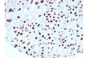 Formalin fixed paraffin embedded human colon carcinoma stained with p21 Recombinant Mouse Monoclonal Antibody (rCIP1/6907) at 2 μg/mL. (Recombinant p21 antibody  (AA 1-100))