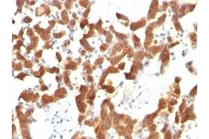 Formalin-fixed, paraffin-embedded human thyroid carcinoma stained with Cytokeratin 18 antibody (KRT18/834). (Cytokeratin 18 antibody)