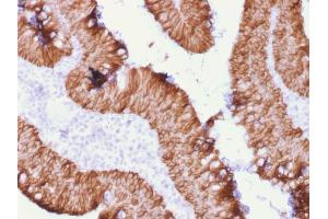 Formalin-fixed, paraffin-embedded human Rectal Mass stained with EpCAM Mouse Recombinant Monoclonal Antibody (rEGP40/1372). (Recombinant EpCAM antibody  (Extracellular Domain))