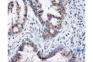 Immunohistochemical staining of paraffin-embedded Adenocarcinoma of colon tissue using anti-SHC1 mouse monoclonal antibody. (SHC1 antibody)