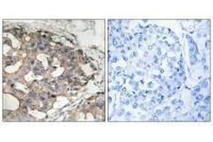 Immunohistochemistry analysis of paraffin-embedded human breast carcinoma tissue using B-RAF (Ab-446) antibody. (BRAF antibody  (Ser446))