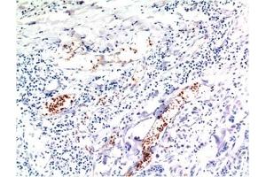 Immunohistochemical analysis of paraffin-embedded Human Breast Carcinoma Tissue using TGFβ1 Mouse mAb diluted at 1:200. (TGFB1 antibody)