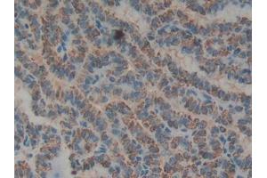 IHC-P analysis of Human Thyroid cancer Tissue, with DAB staining. (Biglycan antibody  (AA 48-158))