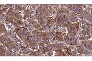 ABIN6273613 at 1/100 staining Human liver cancer tissue by IHC-P. (TNFSF18 antibody)