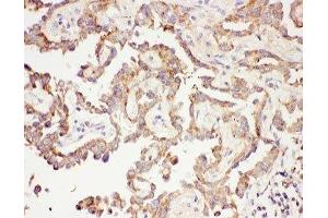 IHC-P: Galectin 3 antibody testing of human lung cancer tissue (Galectin 3 antibody  (AA 139-250))