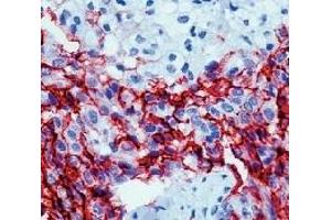 Formalin fixed paraffin embedded human mesothelioma stained with Mesothelioma antibody. (Mesothelioma antibody)