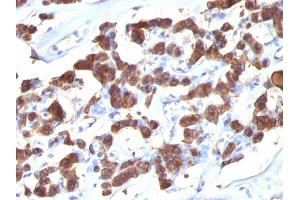 Formalin-fixed, paraffin-embedded human Thyroid stained with Thyroglobulin Ab (2H11 + 6E1). (Thyroglobulin antibody)