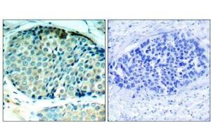 Immunohistochemical analysis of paraffin-embedded human breast carcinoma tissue using HSP27(Phospho-Ser78) Antibody(left) or the same antibody preincubated with blocking peptide(right). (HSP27 antibody  (pSer78))