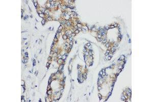 Anti-CD1d antibody, IHC(P) IHC(P): Human Mammary Cancer Tissue (CD1d antibody  (N-Term))