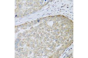 Immunohistochemistry of paraffin-embedded human liver cancer using ANAPC10 antibody. (ANAPC10 antibody  (AA 1-185))