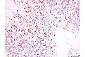 Formalin-fixed and paraffin embedded human neurological glioblastoma labeled with Anti-OPRD1 (Ser363) Polyclonal Antibody, Unconjugated  at 1:200 followed by conjugation to the secondary antibody and DAB staining. (OPRD1 antibody  (pSer363))