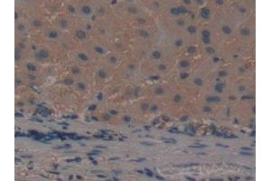 IHC-P analysis of Human Liver cancer Tissue, with DAB staining. (ADAMTS5 antibody  (AA 485-622))