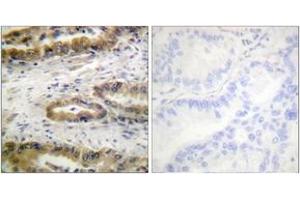 Immunohistochemistry analysis of paraffin-embedded human lung carcinoma, using VEGFR2 (Phospho-Tyr1054) Antibody. (VEGFR2/CD309 antibody  (pTyr1054))
