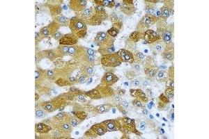 Immunohistochemical analysis of ACADS staining in human liver cancer formalin fixed paraffin embedded tissue section. (ACADS antibody)