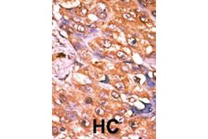 Formalin-fixed and paraffin-embedded human cancer tissue reacted with the primary antibody, which was peroxidase-conjugated to the secondary antibody, followed by AEC staining. (PDGFRB antibody  (pTyr579))