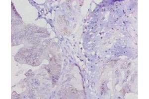 Immunohistochemistry of paraffin-embedded human colon cancer using ABIN7158833 at dilution of 1:20 (LOXL1 antibody  (AA 106-574))