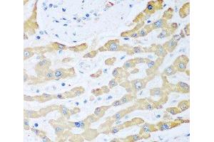 Immunohistochemistry of paraffin-embedded Human liver cancer using FDXR Polyclonal Antibody at dilution of 1:100 (40x lens). (Ferredoxin Reductase antibody)