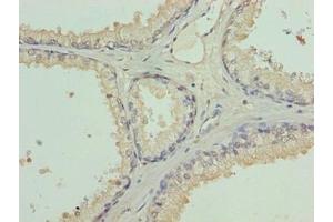 Immunohistochemistry of paraffin-embedded human prostate cancer using ABIN7158010 at dilution of 1:100 (L3MBTL4 antibody  (AA 1-270))