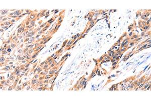 Immunohistochemistry of paraffin-embedded Human esophagus cancer using GNRHR Polyclonal Antibody at dilution of 1:117 (GNRHR antibody)