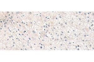Immunohistochemistry of paraffin-embedded Human liver cancer tissue using FGFR4 Polyclonal Antibody at dilution of 1:25(x200) (FGFR4 antibody)