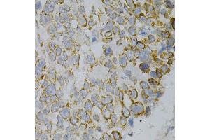 Immunohistochemistry of paraffin-embedded human esophageal cancer using GNAO1 Antibody. (GNAO1 antibody)