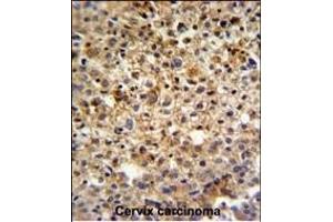 KI Antibody (C-term) (ABIN651358 and ABIN2840200) IHC analysis in formalin fixed and paraffin embedded human cervix carcinoma followed by peroxidase conjugation of the secondary antibody and DAB staining. (CCDC180 antibody  (C-Term))