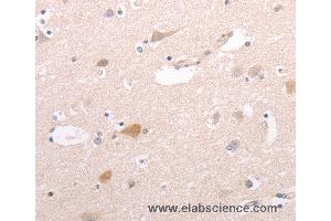 Immunohistochemistry of Human cervical cancer using CIDEB Polyclonal Antibody at dilution of 1:50 (CIDEB antibody)