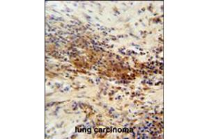 DNAJC11 antibody immunohistochemistry analysis in formalin fixed and paraffin embedded human lung carcinoma followed by peroxidase conjugation of the secondary antibody and DAB staining. (DNAJC11 antibody  (N-Term))