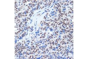 Immunohistochemistry of paraffin-embedded human thyroid cancer using RING1A Rabbit mAb (ABIN7270051) at dilution of 1:100 (40x lens). (RING1 antibody)