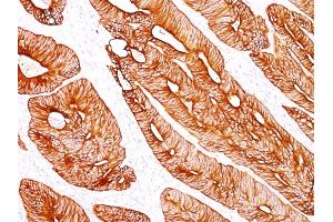 Formalin-fixed, paraffin-embedded human Colon Carcinoma stained with Cytokeratin 8 Mouse Monoclonal Antibody (K8/383). (KRT8 antibody)