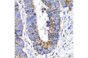 Immunohistochemistry of paraffin-embedded human colon carcinoma using RALB antibody (ABIN6293713) at dilution of 1:100 (40x lens). (RALB antibody)