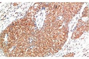 Immunohistochemistry of paraffin-embedded Human breast carcinoma tissue using ATM Monoclonal Antibody at dilution of 1:200. (ATM antibody)