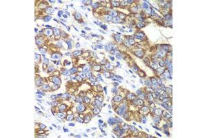 Immunohistochemistry of paraffin-embedded human gastric cancer using RALB antibody (ABIN6293713) at dilution of 1:100 (40x lens). (RALB antibody)