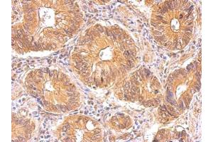 IHC-P Image Insulin Receptor antibody detects INSR protein at cytosol on human gastric cancer by immunohistochemical analysis. (Insulin Receptor antibody  (C-Term))