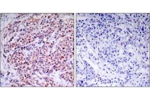Immunohistochemistry analysis of paraffin-embedded human breast carcinoma tissue, using NF-kappaB p65 (Ab-435) Antibody. (NF-kB p65 antibody  (AA 402-451))
