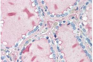 Human Thyroid (formalin-fixed, paraffin-embedded) stained with TG antibody ABIN396966 at 10 ug/ml followed by biotinylated anti-mouse IgG secondary antibody ABIN481714, alkaline phosphatase-streptavidin and chromogen. (Thyroglobulin antibody)