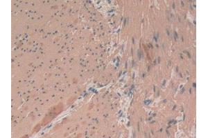 IHC-P analysis of Human Rectum Cancer Tissue, with DAB staining. (Smooth Muscle Actin antibody  (AA 167-377))