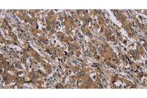 Immunohistochemistry of paraffin-embedded Human liver cancer tissue using MAL Polyclonal Antibody at dilution 1:30 (MAL antibody)