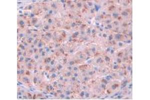 IHC-P analysis of Human Liver Cancer Tissue, with DAB staining. (IL-10RA antibody  (AA 132-235))