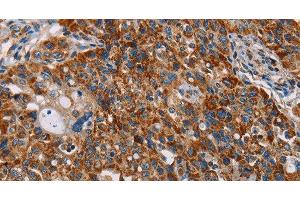 Immunohistochemistry of paraffin-embedded Human lung cancer tissue using ALG2 Polyclonal Antibody at dilution 1:35 (ALG2 antibody)